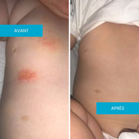 Avant après crème eczéma buste