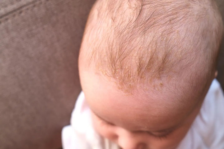 Dermatite séborrhéique bébé