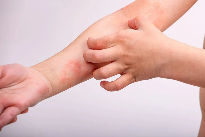 eczema enfant
