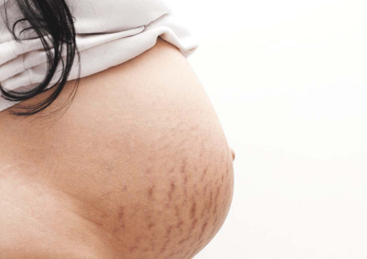 Nos solutions pour enlever mes vergetures violettes de grossesse ?