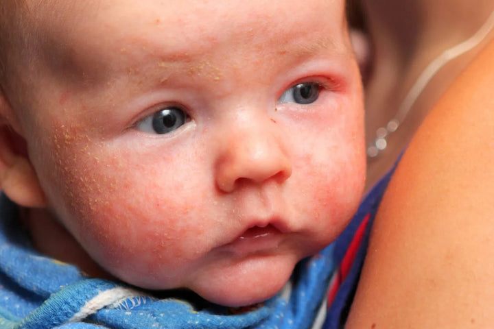 les symptomes de l'eczema chez bebe