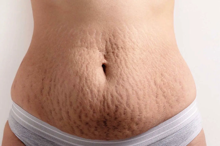 vergeture ventre grossesse