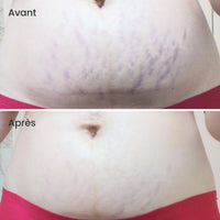 avant après réparation vergetures grossesse