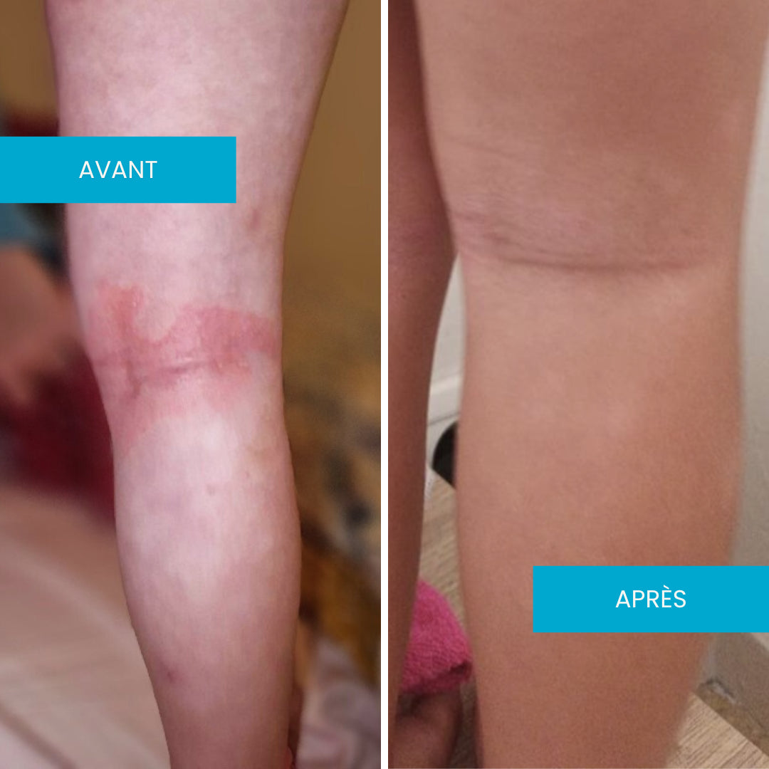 Avant après crème eczéma jambe