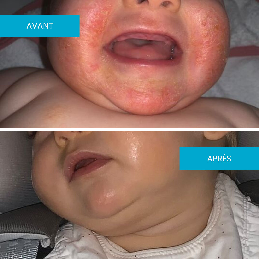 Avant après crème eczéma visage